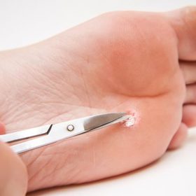 Bradavice se často vyskytují na chodidlech.