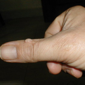 Bradavice jsou nepříjemné.