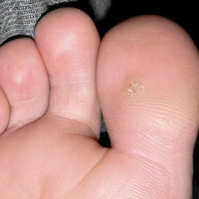 Zbavte se bradavic jednou provždy.