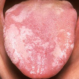 Diagnóza: Leukoplakie.