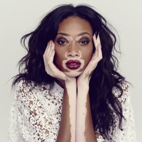 1. Chantelle Brown-Yung. Tato Kanaďanka se živí modelingem, přestože trpí poruchou pigmentace.