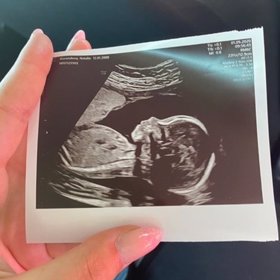 Laky Royal ukázal i snímek z ultrazvuku.