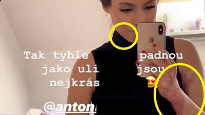 FOTO: Týnuš ukázala, kde všude jí zasáhl oheň.