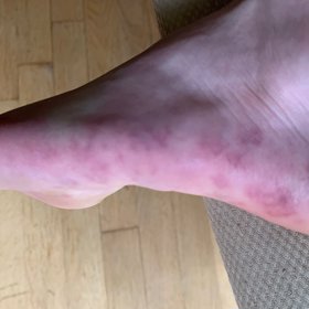 Jeden z mnoha příznaků koronaviru.