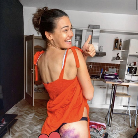 Andrea Kalousová vyděsila fanoušky modřinou. 