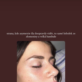 Důvodem operace byl úraz z dětství, díky kterému špatně dýchala. Ten způsobil také asymetrii a hrbolek, se kterým nebyla influencerka spokojená. 