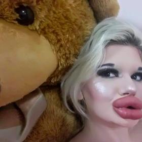 Andrea se pyšní největšími rty světa: S přifukováním nekončí, asi jí prasknou, píší lidé