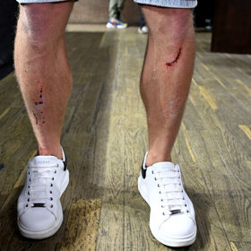 Zatímco Benda skončil s tržnou ranou pod okem, i Žralok si z incidentu odnesl "památku". 