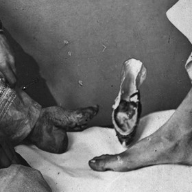 Rozdíl mezi svázaným a normálním chodidlem byl markantní.