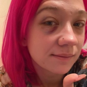 Modřiny si Tereza Mašková způsobila častým zvracením.