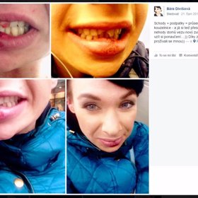 Reportérka a moderátorka Bára Divišová poté, co po hádce s bývalým partnerem přišla o zuby.