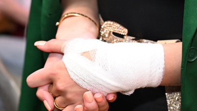 FOTO: Natálie Kočendová si zranila ruku.