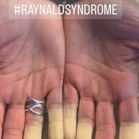 Herečka Ivana Jirešová trpí syndromem bílých prstů. Fotografii sdílela na svých sociálních sítích.