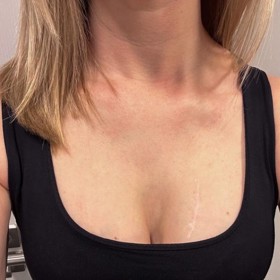 Jizva, která moderátorce Soni Porupkové zůstala po zhoubném znaménku.