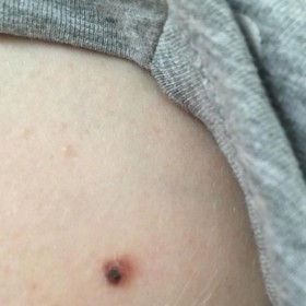 Tam jí také v 27 letech začalo zlobit znaménko, které roky vypadalo jako běžná piha. Rostlo, měnilo tvar a svědělo. Soňa s ním přesto dlouho váhala jít k lékaři.