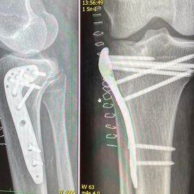 Rentgenový snímek nohy krásné modelky. 