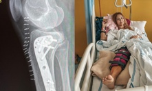 Modelka Iveta Kindlmanová stále čeká na spravedlnost: Po nehodě bojovala o nohu