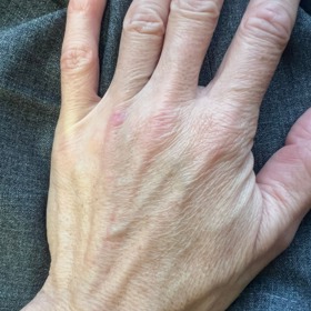 Levá ruka zůstala bez ošetření.