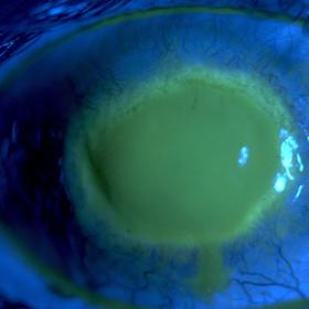 Pacient s akantamébovou keratitidou v oku.