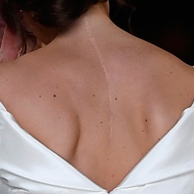 Princezna má na zádech dlouhou jizvu po operaci páteře, kterou podstoupila ve 12 letech.