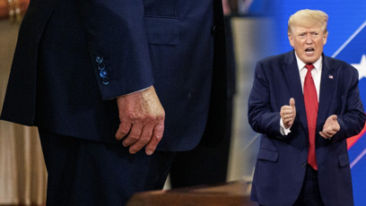 FOTO: Donald trump má chronickou žilní nedostatečnost.