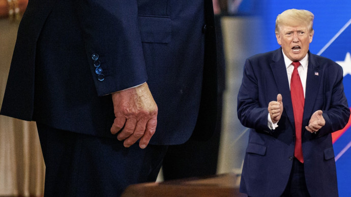 FOTO: Donald trump má chronickou žilní nedostatečnost. – stránka 16