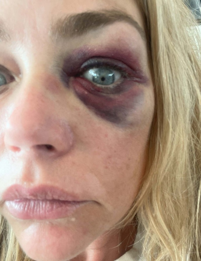 FOTO: Denise Richards měl údajně zmlátit její manžel Aaron Phypers. – stránka 3