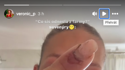 FOTO: Veve ukázala zranění, která si odnesla z Farmy.