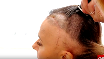 FOTO: Laďka Něrgešová a její jizva po operaci.