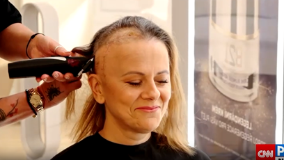 FOTO: Laďka Něrgešová ukázala velkou jizvu.