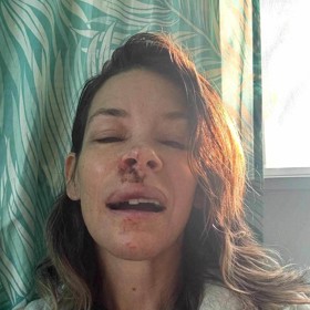 Herečka má poškozený mozek.