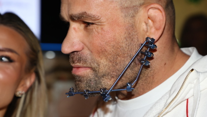 FOTO: Karlos Vémola má na čelisti speciální přístroj.