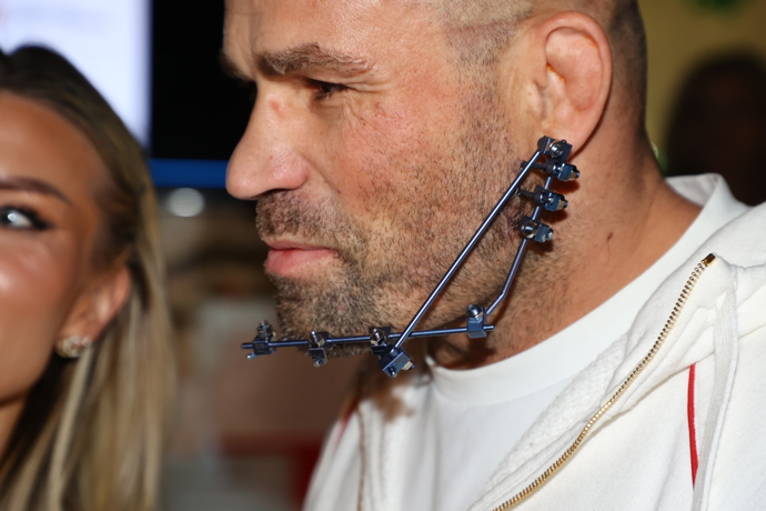 FOTO: Karlos Vémola má na čelisti speciální přístroj. – stránka 17