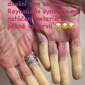 Ivana Jirešová má tzv. Raynaudův syndrom.
