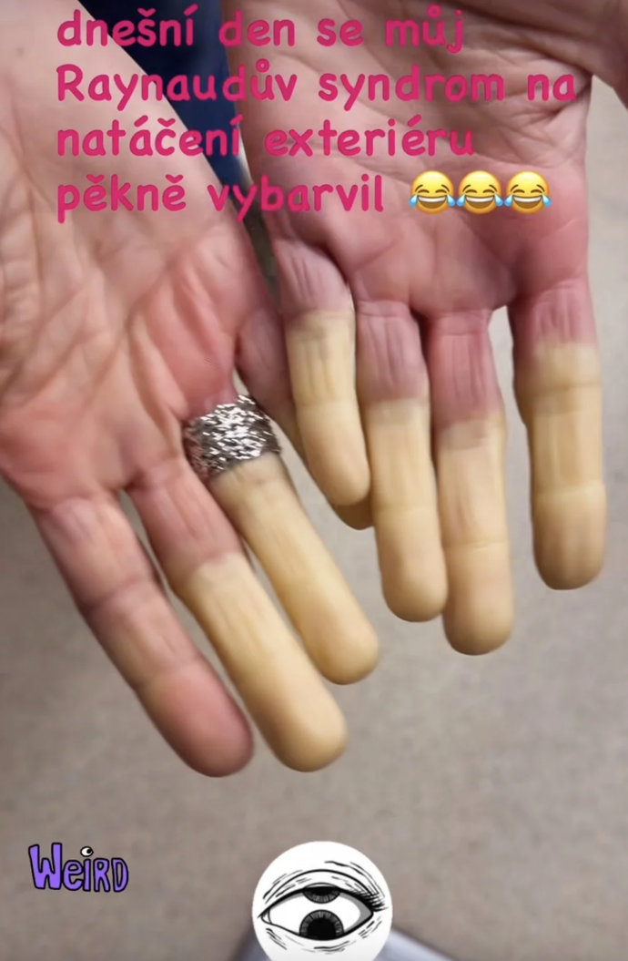 FOTO: Ivana Jirešová má tzv. Raynaudův syndrom.