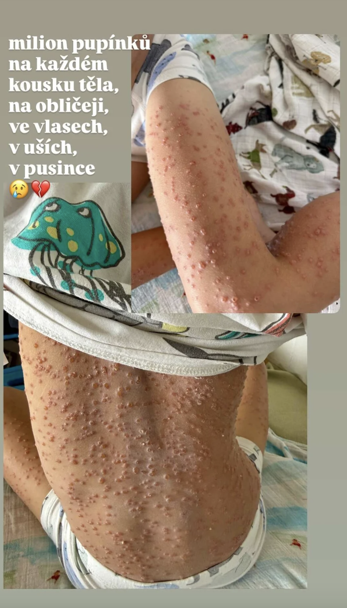 FOTO: Malý Oliver má agresivní formu neštovic.
