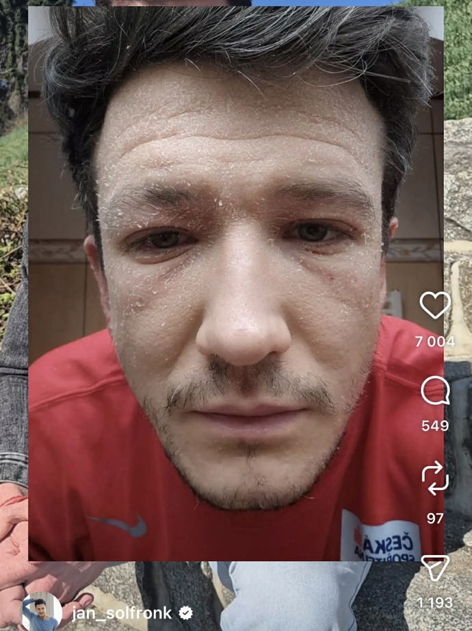 FOTO: Jan Solfronk v době, kdy byl jeho stav velmi vážný. – stránka 1