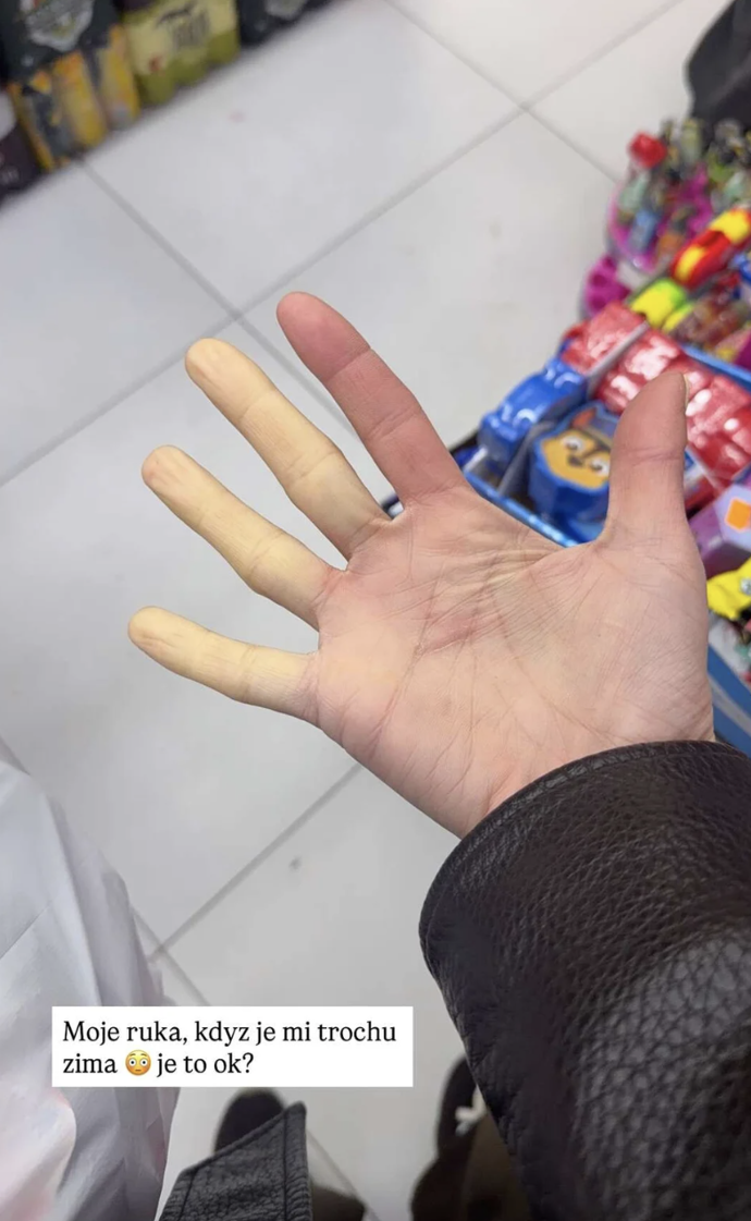 FOTO: Aneta Vignerová má takzvaný Raynaudův syndrom. – stránka 6