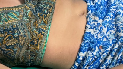 FOTO: Odřeniny na rukou.