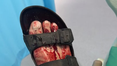 FOTO: Zakrvavená noha.