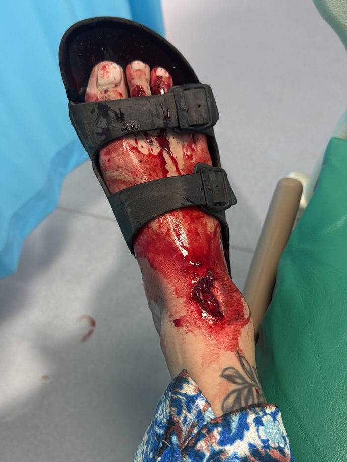 FOTO: Zakrvavená noha. – stránka 3