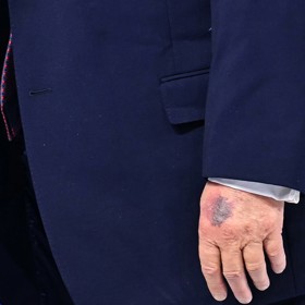 Zdraví Donalda Trumpa se opět diskutuje. 