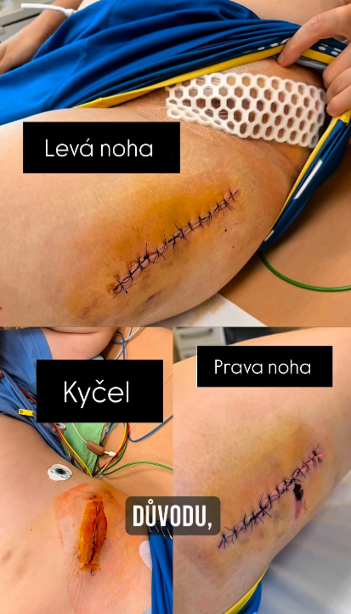 FOTO: Adam Choma podstoupil další operaci. – stránka 4