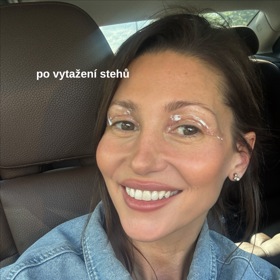 Tereza Kerndlová podstoupila operaci víček.