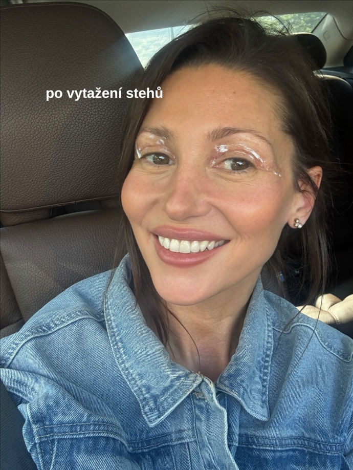 FOTO: Tereza Kerndlová podstoupila operaci víček. – stránka 4